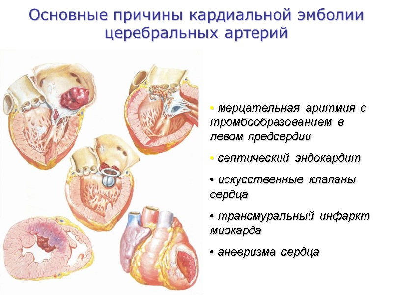 Основные причины кардиальной эмболии церебральных артерий  мерцательная аритмия с тромбообразованием в левом предсердии